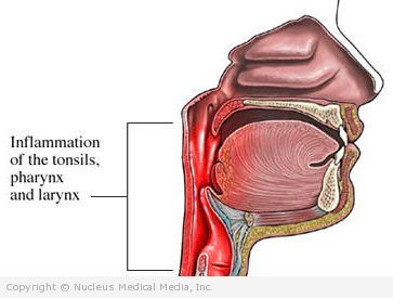 Inflammation In Throat 43