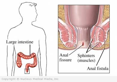 fissure complications Anal surgery