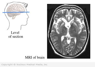 MRI Scan of the Brain