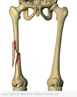 Fractura Femoris