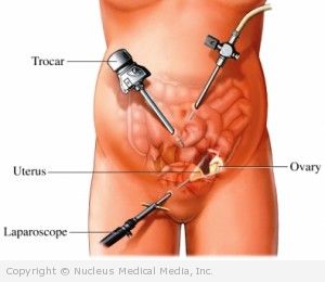 Laparoscopic-Assisted Vaginal Hysterectomy