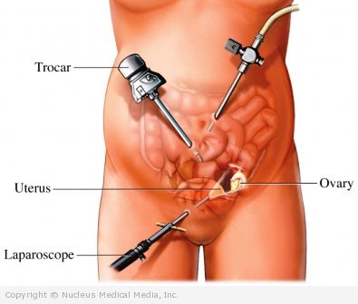 Laparoscopic-Assisted Vaginal Hysterectomy