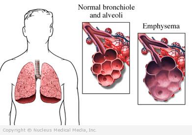 Normal Lung vs Emphysemic Lung