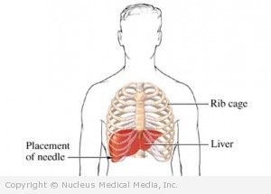 Placement of Liver Biopsy Needle