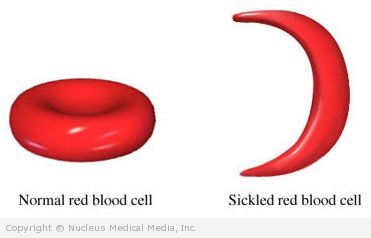 Sichelzellenanamie Beschreibung Diagnose Behandlung Herz Und Blutzustande